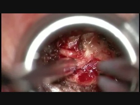 Foraminotomia i mikrodiscektomia szyjna