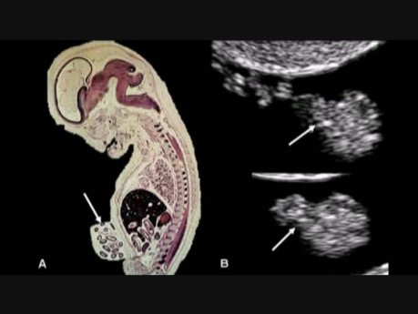 Ultrasonografia we wczesnej ciąży