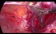 Wznowa endometriozy w bliźnie po trokarze