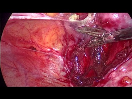 Wznowa endometriozy w bliźnie po trokarze