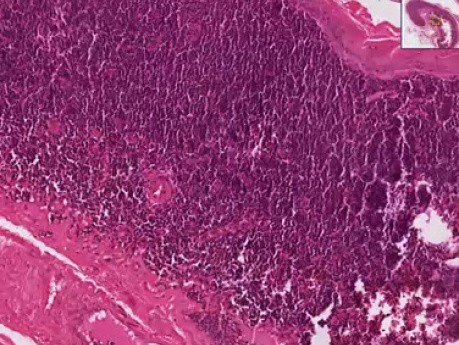 Torbiel skrzelowa (cyst lymphoepithelial) - Badanie histopatologiczne szyi