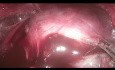 TOETVA - transoroalna endoskopowa tyreoidektomia z dojścia przedsionkowego