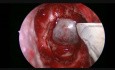 Endoskopowe przezklinowe usunięcie gruczolaka przysadki.