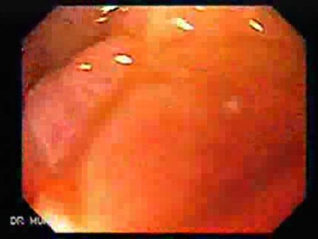 Rak włóknisty żołądka - barwienie płynem Lugola (7 z 15)
