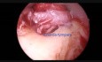Stapedektomia endoskopowa