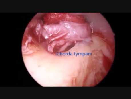 Stapedektomia endoskopowa