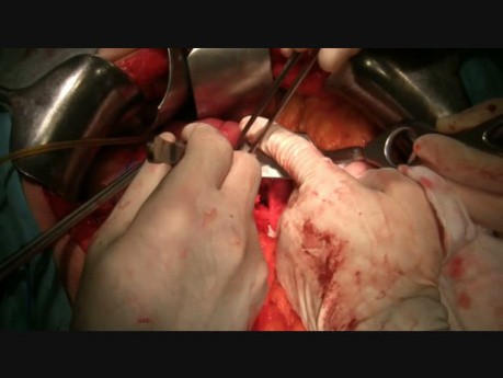 Metoda "serous touch" w chirurgii trzustki