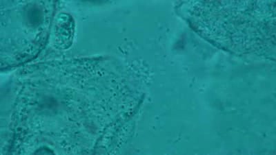 Bakteryjne zapalenie pochwy - Komórki jeżowe