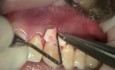 Implanty kolagenowe - nadzieja periodontologicznej chirurgii plastycznej