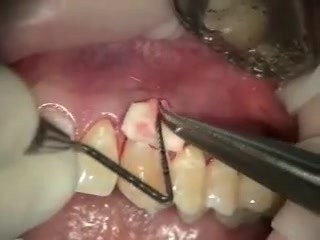 Implanty kolagenowe - nadzieja periodontologicznej chirurgii plastycznej