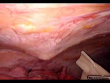 Perforacja okrężnicy z zapaleniem otrzewnej - laparoskopia (46 z 46)