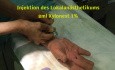 Endoskopische Karpaltunneloperation