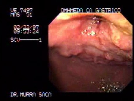 Rak części przedodźwiernikowej żołądka - endoskopia (1 z 2)