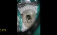 Leczenie endodontyczne zębów przedtrzonowych żuchwy (3 kanały)