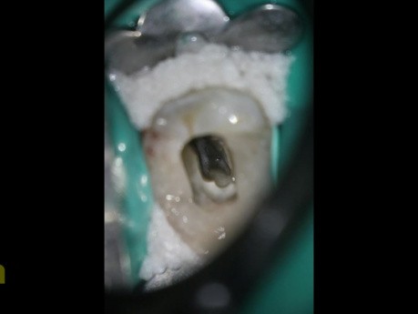 Leczenie endodontyczne zębów przedtrzonowych żuchwy (3 kanały)