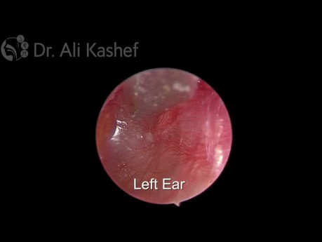 Założenie drenów wentylacyjnych w przebiegu wysiękowego zapalenia ucha środkowego