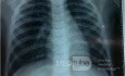 Odoskrzelowe zapalenie płuc