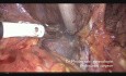 Histerektomia radykalna C1 (oszczędzająca unerwienie) z powodu raka szyjki macicy
