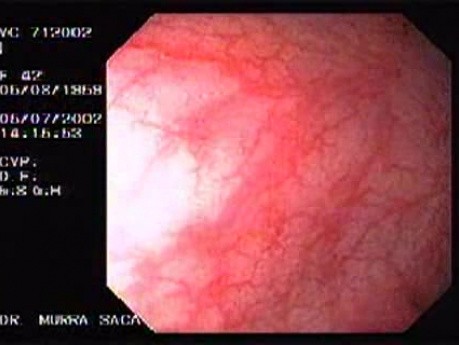 Choroba Leśniowskiego - Crohna - endoskopia (9 z 28)