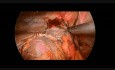 Laparoskopowa operacja przepukliny przeponowej lewostronnej u 12-letniego chłopca