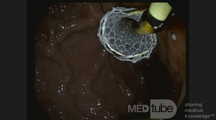Endoskopowa hepaticogastrostomia pod kontrolą EUS [10/10]