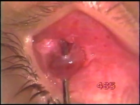 Miomektomia mięśnia skośnego dolnego oka z użyciem noża Fugo