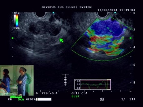 Endoskopowa ultrasonografia – przypadek 5