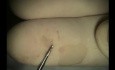 Mikrochirurgia implantologiczna: nieuleczalna resorpcja korzenia