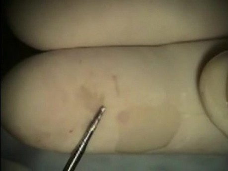 Mikrochirurgia implantologiczna: nieuleczalna resorpcja korzenia