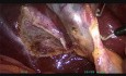 Cholecystektomia metodą mini laparoskopii