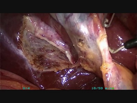 Cholecystektomia metodą mini laparoskopii