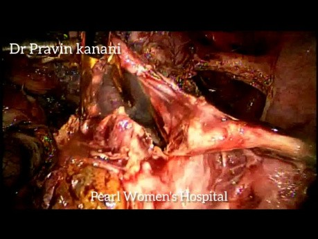 Laparoskopia pękniętej ciąży pozamacicznej z torbielą czekoladową i miomektomia
