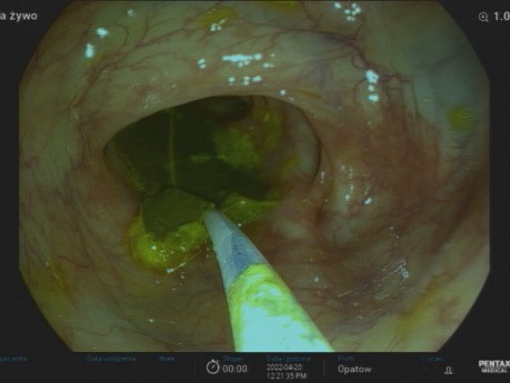 Liść laurowy w jelicie grubym - przypadek medyczny