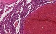 Naczyniak - histopatologia - pierś, tkanka miękka
