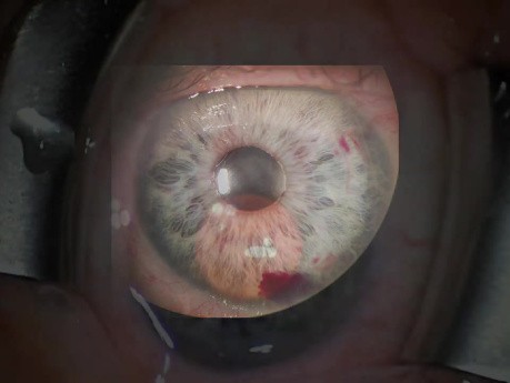 Ukierunkowane wstrzyknięcie małego implantu, technika i strategie implantacji