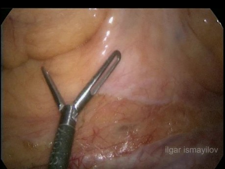 Całkowite wycięcie mezorektum (TME) techniką laparoskopową, częściowa międzyzwieraczowa resekcja z powodu raka dystalnej części odbytnicy