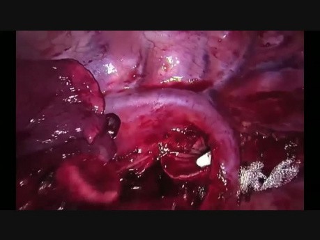 Wideotorakoskopowa rękawowa lobektomia z jednego cięcia