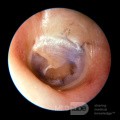 Niebieska rurka wentylacyjna w uchu środkowym