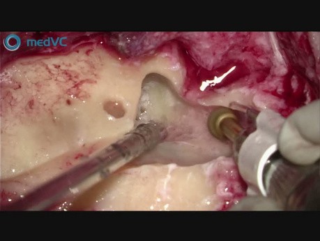 Operacja wszczepu implantu ślimakowego - transmisja na żywo podczas konferencji NEMP 2019