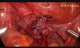 Laparoskopowe wycięcie torbieli jajnika,myomectomia z cholecystektomią