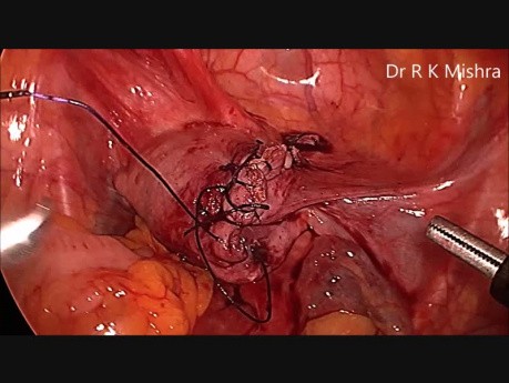 Laparoskopowe wycięcie torbieli jajnika,myomectomia z cholecystektomią