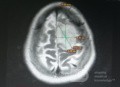 Planowanie operacji z użyciem Neuronavigatora u pacjenta z masą wewnątrzczaszkową. Glejak wysokiego stopnia.