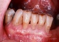 Widoczne korzenie zębowe