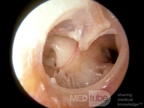 Całkowita perforacja błony bębenkowej z widocznym otworem trąbki Eustachiusza