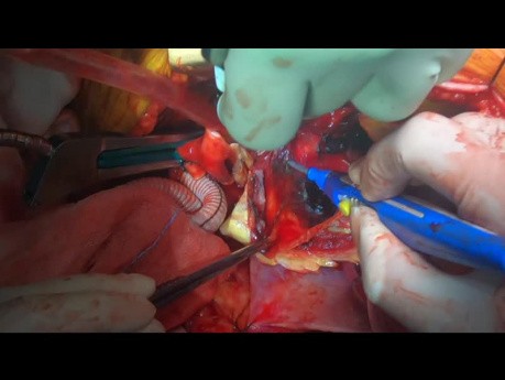Operacja pękniętego tętniaka aorty wstępującej i łuku aorty