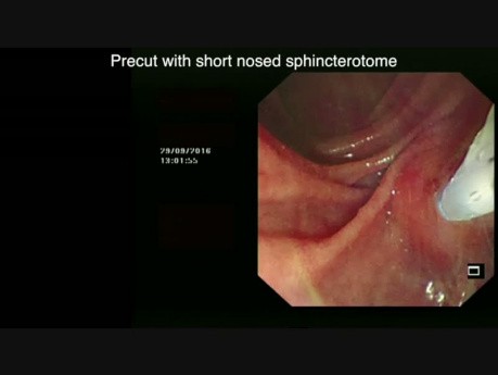 Endoskopowa cholangiopankreatografia wsteczna - ERCP