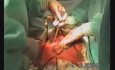 Operacja raka żołądka - usunięcie kikuta żołądka