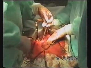 Operacja raka żołądka - usunięcie kikuta żołądka