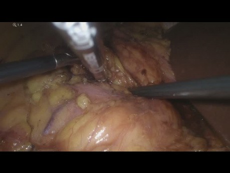 Jednoczesna adrenalektomia laparoskopowa prawostronna i usunięcia guza prawej nerki