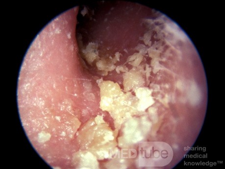 Łuszczyca w przewodzie słuchowym zewnętrznym